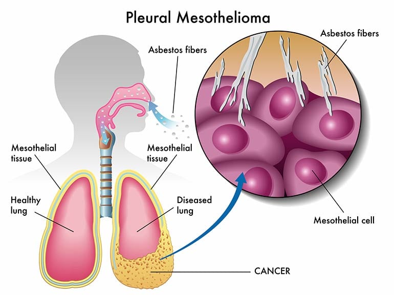 Survival Rates After Diagnosing Mesothelioma