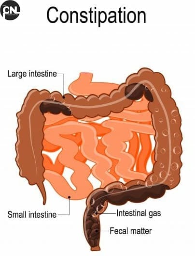 Constipation Treatment in Hindi